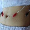 آموزش پکیج لاغری و طب سوزنی
