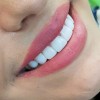 ایمپلنت و زیبایی ،( اقساط)