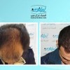 کاشت مو طبیعی با اقساط بلند مدت