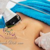 هزینه لاغری با دستگاه آر اف