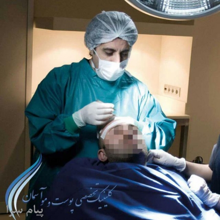 کاشت مو  پیوند مو کاشت موی طبیعی  پیوند موی طبیعی