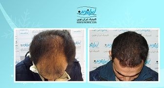کاشت مو طبیعی با اقساط بلند مدت