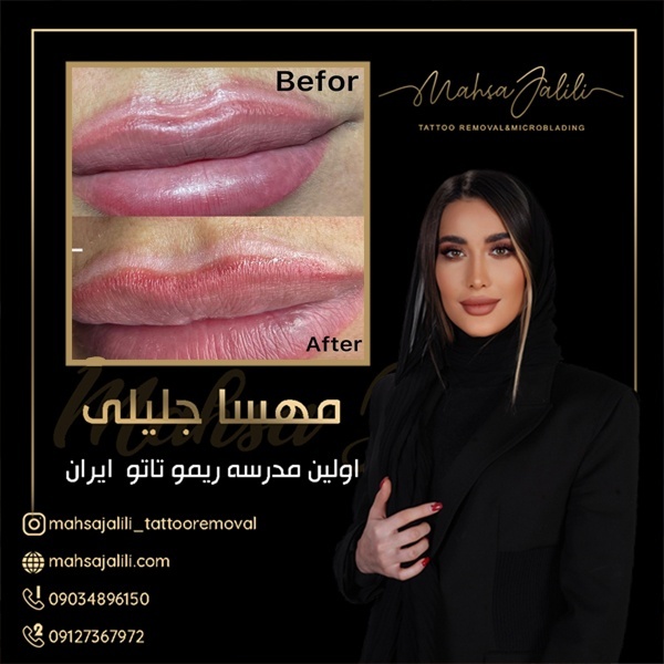 آموزش ریموو تاتو خط لب تضمینی با مهسا جلیلی