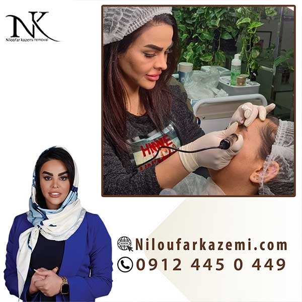 قیمت ریموو تاتو در تهران