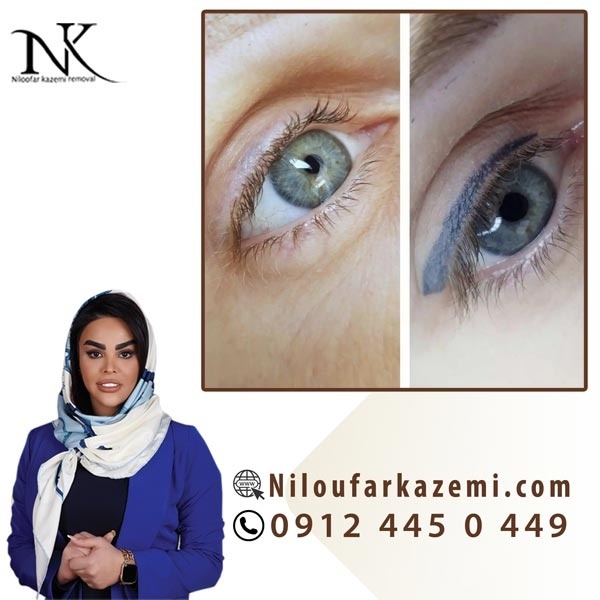 ریموو تاتو خط چشم بدون لیزر