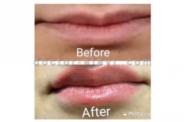قیمت تزریق ژل گونه و لب